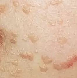 Flaach Papillomas