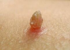 Schaarf Papilloma