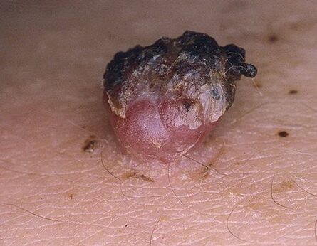 schwaarzt Papilloma