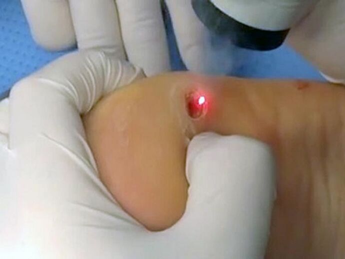 Laser Behandlung fir Warzen