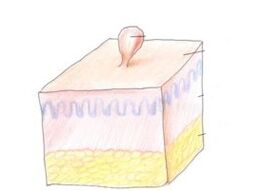 wéi lass vun papilloma op de Kierper