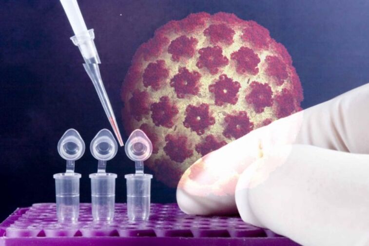 Diagnos vun papillomas