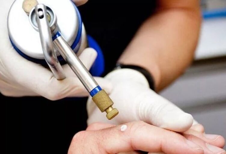 Methode vun der Behandlung vu Papillome