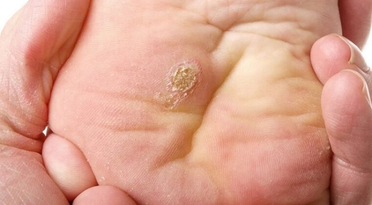 plantar a flaach Papillome