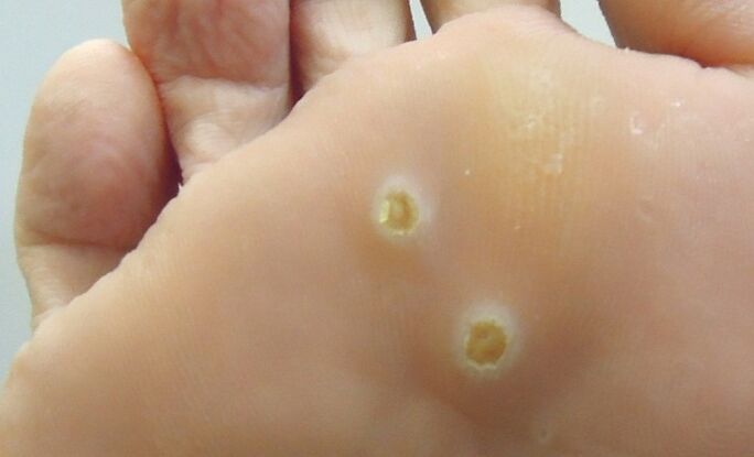 plantar Papillome um Fouss