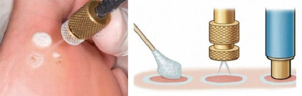 Cryodestruction als Method fir d'Entfernung vu Papillome