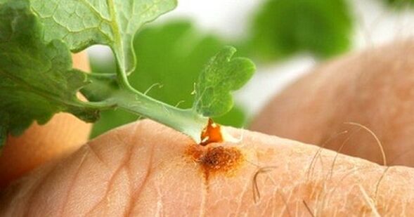 Behandlung vu Warzen mat Celandine