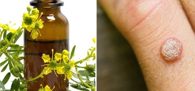 Behandlung vu Warzen mat pharmazeuteschen Celandine