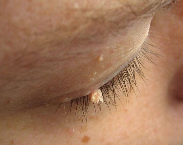 condyloma op der eyelid