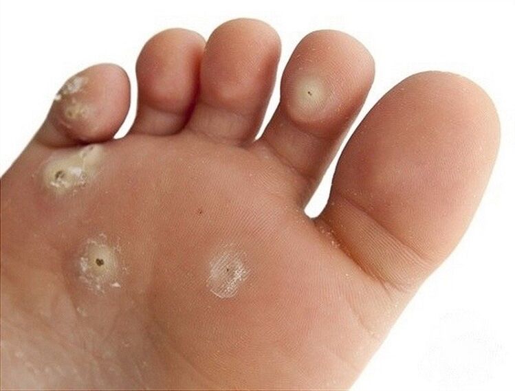 plantar Warzen