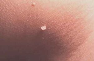 Papilloma op der Haut